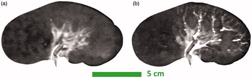 Figure 6. Comparison of CT and MRTI. The pre- (a) and 45-min post-injection (b) CT images of a selective injection experiment are juxtaposed. Both coronal reformatted CT images are inverted grayscale minimum intensity projections that are 5 mm thick. Window/level settings are 168/33. The CT minimum intensity projection and intensity inversion depict the post-injection presence of the mineral oil associated with the heating indicated on MRTI. CT: Computed tomography; MRTI: magnetic resonance thermal imaging.