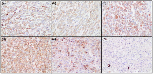 Figure 4. Immunohistochemical images of the case. (a) Positive staining of cytoplasmic granules for pan-cytokeratin (×400). (b) Positive staining of the cytoplasm for laminin (×400). (c) Positive staining of cytoplasm for vimentin (×400). (d) Positive staining of cytoplasm for CD31 (×400). (e) Positive granular staining of the cytoplasm for factor VIII (×400). (f) Negative staining for CD34 (×400).