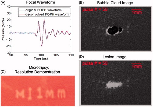 Figure 10. Microtripsy resulting from a single principal negative half-cycle exceeding the intrinsic threshold for cloud cavitation histotripsy. (A) A representative acoustic waveform for a 500-kHz histotripsy pulse measured in water with a fibre-optic probe hydrophone (FOPH). (B) Cavitational bubble cloud and (C) corresponding lesion generated in a red blood cell (RBC) phantom using 500-kHz histotripsy pulses with an estimated peak negative pressure of 26.2 MPa (estimated using linear summation). (D) Demonstration of fine spatial resolution as evidenced in the phrase reading ‘M’ (vertical scale bar 1 mm). (Produced using a 3-MHz transducer, and this figure is adapted from Lin et al. [Citation14]).