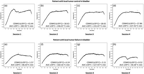 Figure 3. Time–temperature plots for each of the four hyperthermia sessions in a patient who had (a–d) local bladder tumor control and (e–h) who had local bladder tumor failure. Corresponding CEM43 (≥39 °C) and AUC ≥ 39 °C for each of these sessions are stated. The graphs correspond to patient number 15 (a–d) who had no local failure and patient nos. 14 (e–h) who had local failure. The details of the CEM and AUC values for these patients are given in Supplementary Table 1.