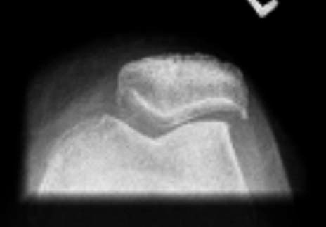 Figure 2. Preoperative skyline view of the patellofemoral joint with lateral subluxation of the patella.