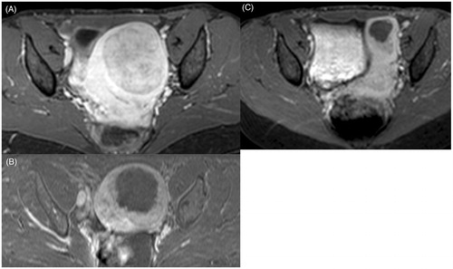 Figure 2. Example of fibroid volume shrinkage at 6 months and the NPV at baseline. All images are axial T1-weighted images obtained with a contrast agent: (A) fibroid before treatment, (B) NPV after treatment, and (C) fibroid at 6 months.