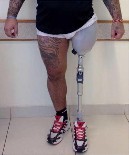 Figure 2. Patient standing with the definitive prosthesis.