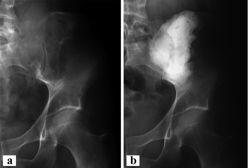 Figure 2. Case 2. a. GCT of the left ilium with sacral extension and proximal cortical breakthrough. b. After intralesional curettage and bone cement packing of the defect.