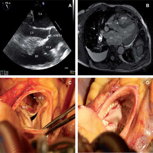 Figure 1. A. Transesophageal echocardiography showing a ruptured sinus of Valsalva (SVA) originating from the right-coronary cusp ending in the right ventricle (RV), left ventricle (LV), left atrium (LA). B. Pre-operative MRI, arrow indicating ruptured sinus of Valsalva aneurysm (SVA). C. Peri-operative picture looking inside the aortic root showing a windsock like aneurismal sac. Right coronary cusp (RCC). D. Peri-operative picture looking inside the aortic root the patch closed defect.