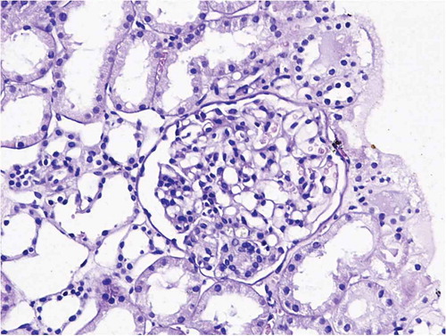 Figure 2.  Result of kidney biopsy: mesangial proliferative glomerulonephritis (prof. Agnieszka Hałon, Department of Pathomorphology, Wroclaw Medical University, Poland).