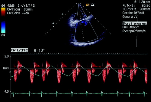 Figure 2. Continuous-wave Doppler spectra displaying respiratory variance of TR velocity in a 64-year-old woman with RV systolic dysfunction. TR velocity in the inspiratory phase decreases significantly compared with that in the expiratory phase.
