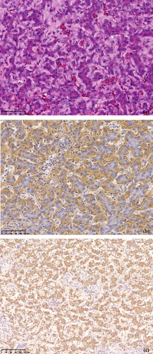 Figure 3. (a) Histopathological changes in the liver of a treated chicken showing amyloid deposition in the space of Disse and hepatic cord atrophy. HE stain. (b) Amyloid shown in the space of Disse in a liver section of a treated chicken. Immunohistochemistry with MX-AA antibodies. (c) SAA mRNA appears strongly positive in hepatocytes of a treated chicken. In situ hybridization.