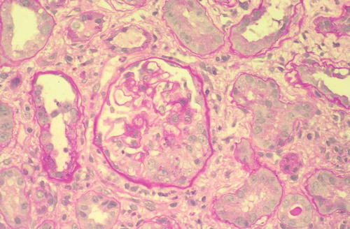 Figure 1. Proliferative extracapillary glomerulonephritis with the formation of a crescentic cell in the lower part of the glomerulus (PAS). × 100