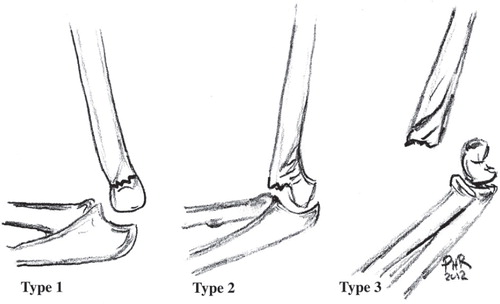 Figure 8. The Gartland classification for supracondylar humerus fractures in children. Type 1: Undisplaced. Type 2: Displaced, with intact posterior cortex. Type 3: Displaced with no bony contact between fragments.