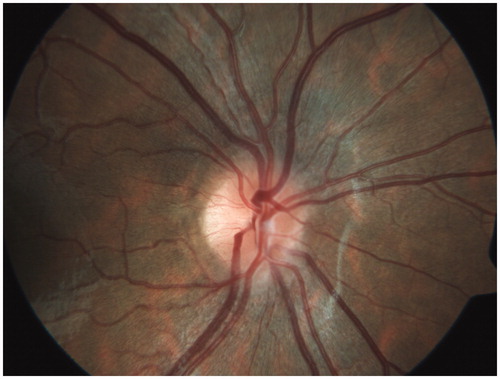 FIGURE 1. Fundus photograph of right eye on admission.