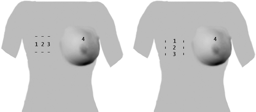 Figure 1.  Illustration of measurement sites. 1 and 3 = Essex or Aloe vera, 2 = no lotion, 4 = healthy breast. Regions 1, 2, 3 can be placed vertical or horizontal.