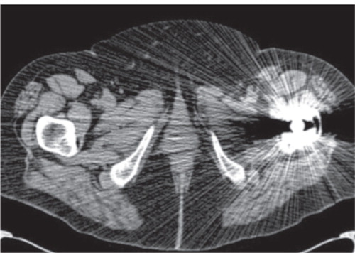 Figure 1. Image used in CitationRobinson et al. 2014. Axial CT image, 64 slice CT scanner, at the level of the prosthetic stem.