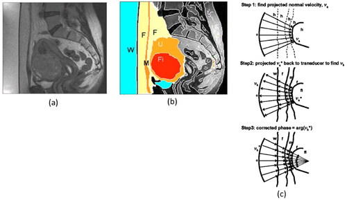 Figure 3. The ray tracing method described by Liu et al. to correct phase errors when focusing through the human abdomen [Citation70]. (a) abdominal magnetic resonance image of a patient receiving therapeutic ultrasound treatment for a uterine fibroid. (b) Segmentation of the patient image into water (W), fat (F), muscle (M), uterus (U), and fibroid (Fi). (c) ray tracing method to determine phase correction. Step 1: Project rays from the transducer assuming a homogeneous (h) medium to find the normal velocity va at the fibroid surface. Step 2: Project the conjugate velocity va* back to a transducer through the heterogeneous path to find vb. Step 3: Extract the corrected phase as arg(vb*). (This figure is adapted from Liu et al. [Citation70]).
