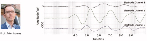 Figure 54. Prof. Artur Lorens led the study in measuring CM directly from the CI during CI surgery. Example of intracochlear ECochG recordings for tone pips and clicks from electrode channels 1, 3, and 5 [Citation56].