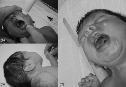 Figure 1. (A) Potter face; (B) large, malformed ears; and (C) cleft palate.