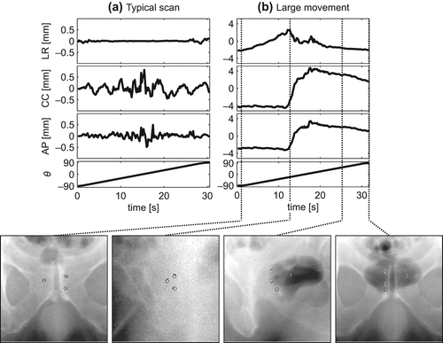 Figure 2. Panel (a) shows a typical result of the analysis of the motion of the prostate during a scan. The result of the analysis with the largest prostate motion observed is shown in panel (b). Also seen in the figure are four selected projection images from this scan. The stationary 3D positions of the seeds found in the reconstructed CBCT data are projected onto the images as circles, while the position of the seeds in the projection images as estimated by the image analysis algorithm are shown as crosses.