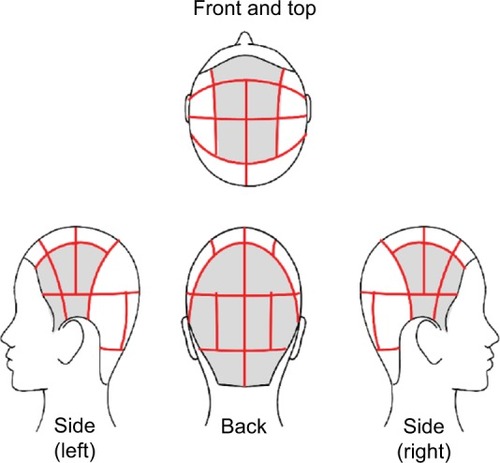 Figure 2 The scalp was divided into 23 areas for the assessment of symptoms that were rated on a scale of 1–4.