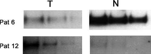 Figure 2.  Example of Western blot analyses of LRIG1 in samples from two colorectal cancer patients. For comparison, the samples were stepwise diluted by 50% in three steps. Tumours (T) versus matched non-neoplastic tissue (N) from the same patient. Pat 6 was considered underexpressing the LRIG1 protein in the tumour compared to adjacent non-neoplastic tissue and Pat 12 was considered as overexpressing the LRIG1 protein in the tumour compared to non-neoplastic tissue.