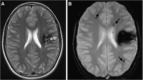 Figure 1 A 32-year-old male with several cavernous malformations who was being evaluated for intraparenchymal hemorrhage. (A) A left frontal cavernous malformation is visible on a T2-weighted image, and it is encircled by a significant haemosiderin ring. (B) Multiple punctate hypointense foci can be seen on the GE T2*-weighted image, which are representative of tiny cavernous malformations in both hemispheres (arrows).Citation18