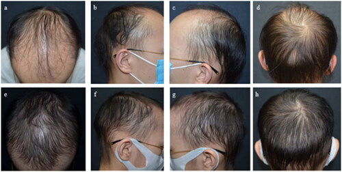 Figure 1. (a–d) Characteristic “U” pattern hair loss; (e–h) a dramatic hair regrowth after 3 months of treatment with tofacitinib.