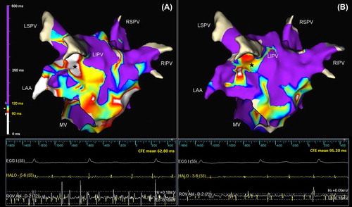 Figure 1. Posterolateral view of the left atrium showing CFE distribution before (A) and after (B) flecainide administration. At baseline, CFE areas cover large portions of the lateral and floor segment (A); these are consistently reduced after flecainide administration (B) but substantially preserved in their original localizations. The color scale for different CFE-mean values is displayed on the left (white: < 80 ms and violet: >120 ms). The tracings in the lower panel demonstrate electrograms from the coronary sinus (HALO-5-6) and lateral wall (ROV Abl-D-2) that were collected in the same position (stars) before (A) and after (B) flecainide administration. A significant decrease in deflections detected (yellow spikes) together with a reduction in electrogram amplitude was observed after flecainide administration. CFE, complex fractionated electrogram; LAA, left atrial appendage; LIPV, left inferior pulmonary vein; LSPV, left superior pulmonary vein; MV, mitral valve; RIPV, right inferior pulmonary vein; RSPV, right superior pulmonary vein.
