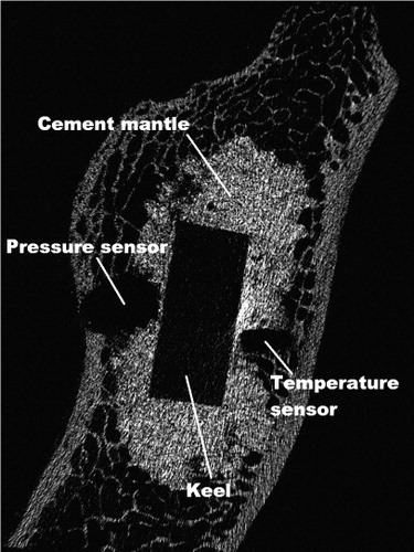 Figure 4.  Frontal micro-CT scan of a glenoid cavity showing a continuous cement mantle around the keel. The drill holes where the pressure and temperature sensors were placed are showing that they had direct contact with the cement.