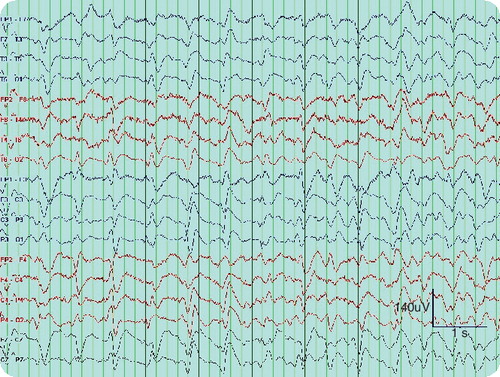Figure 1. EEG sample sent for interpretation.