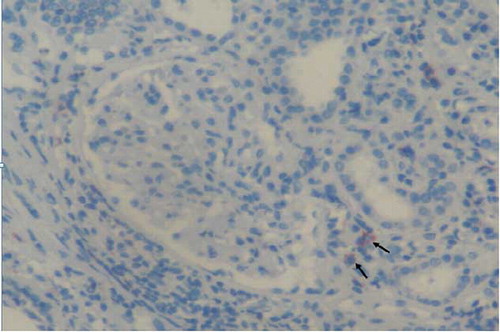 Figure 3. B-cell lymphocytes stained by antibodies CD20 infiltration (arrows) in kidney interstitium (ABP, CD20, ×200). ABP, avidin biotin peroxidase method.