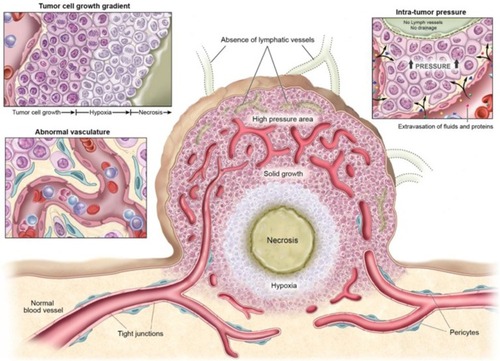 Figure 6 Physiological characteristics of tumor tissues and vasculatures that can restrain drug delivery. Adapted from Kobayashi H, Watanabe R, Choyke PL. Improving conventional enhanced permeability and retention (EPR) effects; what is the appropriate target? Theranostics. 2013;4(1):81–89. Copyright 2013 Ivyspring International Publisher (https://creativecommons.org/licenses/by-nc/4.0/legalcode).Citation62