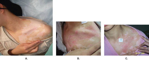 Figure 1. (A) Segmental vitiligo on the left shoulder before the first operation; (B) repigmentation took place within 4 weeks, with slight hyperpigmentation and redness; (C) successful pigmentation was observed 7 months after the first operation.