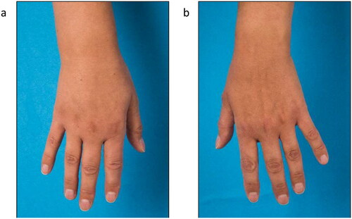 Figure 2. Lymphedema of the right forearm and back of the hand at initial presentation (a) right hand, (b) left hand).