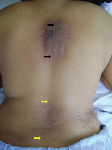 Figure 1. Differential “radiation recall” reactions at dorsal and lumbar regions. The area between the black arrows represents the portal for the dorsal spine (severe recall) while the area between the yellow arrows represents the portal for lumbar spine (very mild recall).