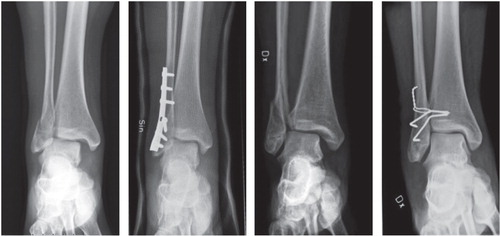 Figure 2. Typical fractures and treatment with the AO method (left panels) and the Cedell method (right panels).
