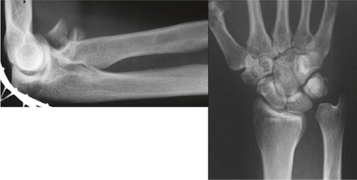 Figure 1. An Essex-Lopresti lesion: comminuted fracture of the radial head, resulting in proximalization of the radius and dislocation of the unstable distal radio-ulnar joint.