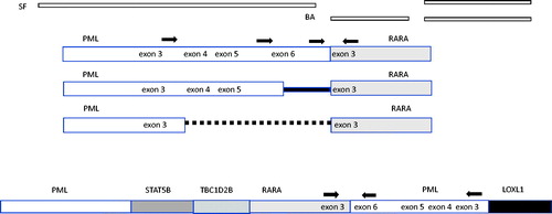 Figure 2. Structure and suggested structure of classical and cryptic translocations. Binding location of the single fusion (SF), break apart (BA) probes and RT-qPCR primers (arrows) are shown. In the classical APL t(15;17) translocations, the PML gene breaks at three breakpoint cluster regions (bcrs): intron 6 (bcr1), exon 6 (bcr2) and intron 3 (bcr3). RARA breakpoints occur in intron 2. A proposed structure based molecular analysis includes intra-chromosomal rearrangement of PML in addition to the insertion of RARA.