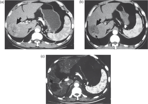 Figure 3. Transverse contrast-enhanced CT scans in patient 2. (a) Pre-ablation scan showed a 6.4 × 6.1 cm cancer nodule (arrows) in the right lobe. (b) Scan obtained one month after the first session of ablation showed an incomplete ablation (residual area indicated by the narrow arrow) with a 6.4 × 5.3-cm coagulation zone (indicated by the wide arrow). (c) Scan obtained two weeks after the second session of ablation showed a complete ablation with a 5.8 × 5.2-cm coagulation zone (indicated by the wide arrow).