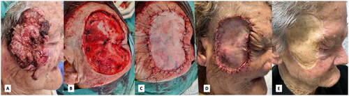 Figure 1. Clinical evolution with surgery: (A) aspect at diagnosis; (B) wide resection with safety margins; (C) Graft implantation; (D) One week after surgery; (E) Seven months after surgery.