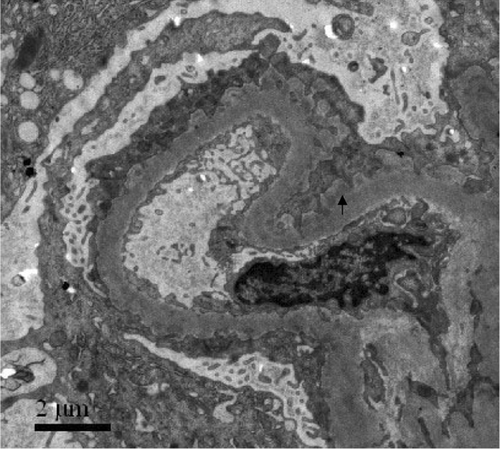 Figure 1. Subepithelial electron-dense deposits were seen by electron microscope (arrowheads).