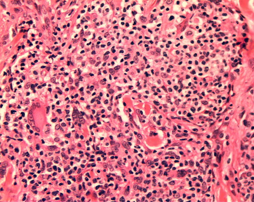 Figure 5.  Epithelioid and multinucleated giant cells admixed with neoplastic cells (HE, ×250).