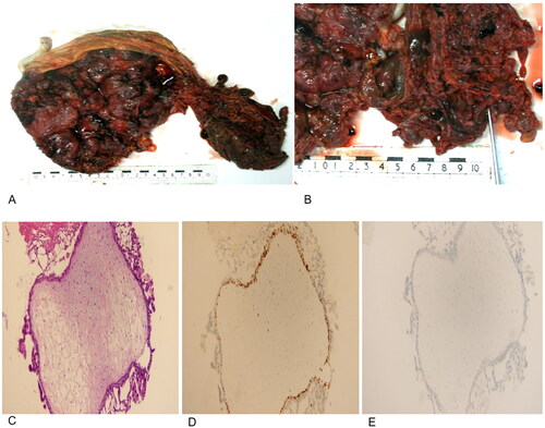 Figure 2. Pathology of the patient’s placenta. (A,B) Gross pathological assessment following delivery. A placenta from a normal pregnancy is presented adjacent to the complete molar tissues. (C) Hematoxylin-eosin staining results of the complete hydatidiform mole. (D) Ki-67 expression in the complete hydatidiform mole (+). (E) p57 expression in the complete hydatidiform mole (-).