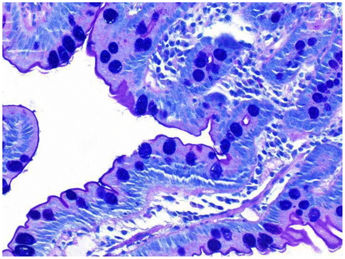 Figure 6 Duodenal biopsy stained with AB–PAS, ×40. The goblet cell mucin is stained blue. There is also pink–red-colored neutral mucin present. The mucin in the goblet cells is a mixture of neutral and acidic mucins giving a bluish purple color.
