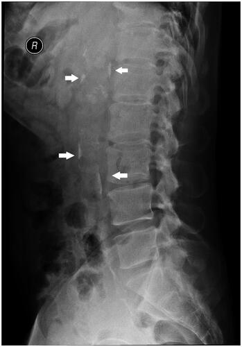 Figure 2. Radiological quantification of abdominal aortic calcification using abdominal lateral X-ray. Arrowhead denotes calcification sites.