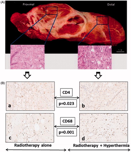 Figure 2. (A) Resected tumour with insets showing the histopathology of the proximal part treated with radiotherapy alone and the distal part treated with thermotherapy. A relatively increased cellular infiltration in the part treated with hyperthermia could be noted. (B) Immunohistochemistry photomicrographs for CD4 (a, b), CD68 (c, d). The immunohistochemistry from the part treated with radiotherapy alone is depicted in panels a and c, while b and d are from the parts treated with thermoradiotherapy.