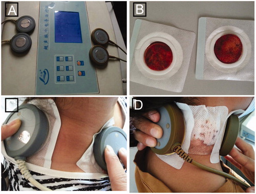Figure 1. Transdermal delivery with EP. (A) Ultrasonic conductometric instrument used in this study. Each ultrasonic conductometric instrument has two pairs of probes that can be used for two patients at the same time. (B) Two patches immersed with RIF solution. (C) and (D) Patients with intumescent or ruptured lymph nodes were given RIF-transdermal patches through EP.