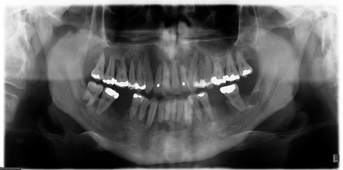 Figure 1. Marked periodontal as well as bony lesions in the maxilla and mandible. Initially this was clinically interpreted as advanced periodontal disease (radiograph from 2007).