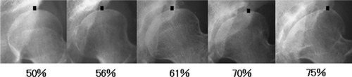 Figure 4. Various degrees of deformity of the femoral head and the associated roundness index. As deformation of the femoral head increases, the top of the femoral head moves laterally. The black square shows the top of the femoral head.