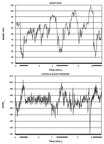 Figure 2 Heart rate (upper tracing) and systolic blood pressure (lower tracing) during three separate paroxysms (indicated by dark lines along the time axis). Copyright © 1991. Reproduced with permission from CitationKruszewski P, Fasano M, Brubakk AO, et al. 1991. Short-lasting, unilateral neuralgiform headache attacks with conjunctival injection, tearing, and subclinical forehead sweating (“SUNCT syndrome): II Changes in heart rate and arterial blood pressure during pain paroxysms. Headache, 31:399–405.