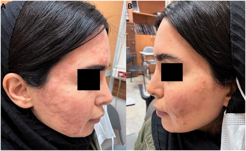 Figure 4. (A/B) Decrease in number and size of papules following one month of treatment with thalidomide.