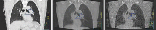Figure 1. Coronal view of one phase in the 4D-CT, the 3D-CBCT and one phase of the 4D-CBCT for a patient with a lung tumour attached to mediastinum. The visual image quality is clearly reduced from 4D-CT to 4D-CBCT.